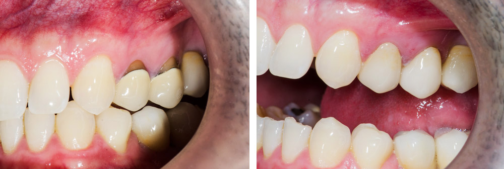 Fotografía Dental Antes y Después, Prótesis y Coronas