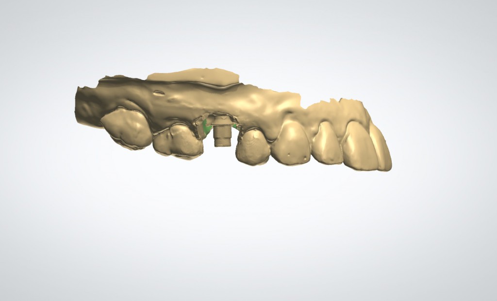 Escaneo 3D de Implante