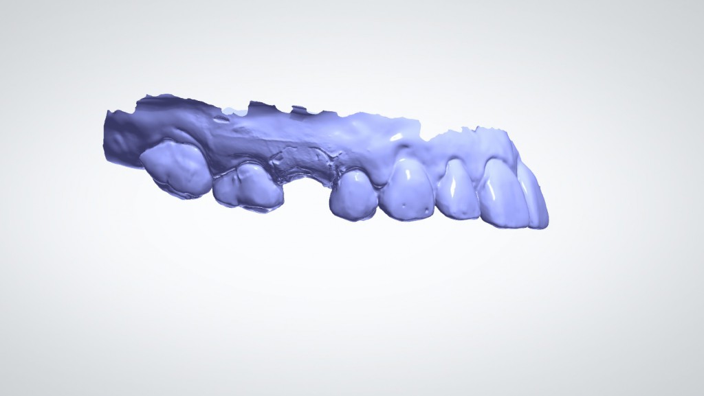 Escaneo 3D de Implante