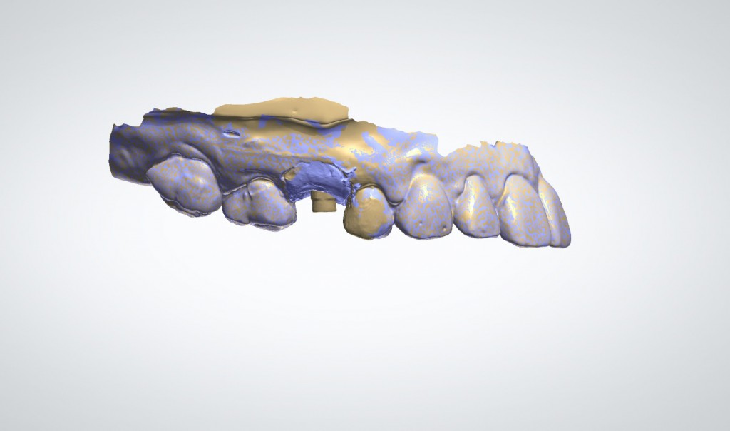 Escaneo 3D de Implante y Encia