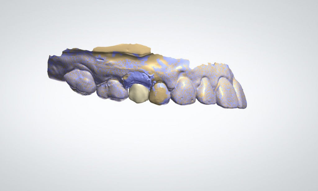 Escaneo 3D de Implante Encía y Corona