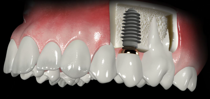 Implantes dentales header