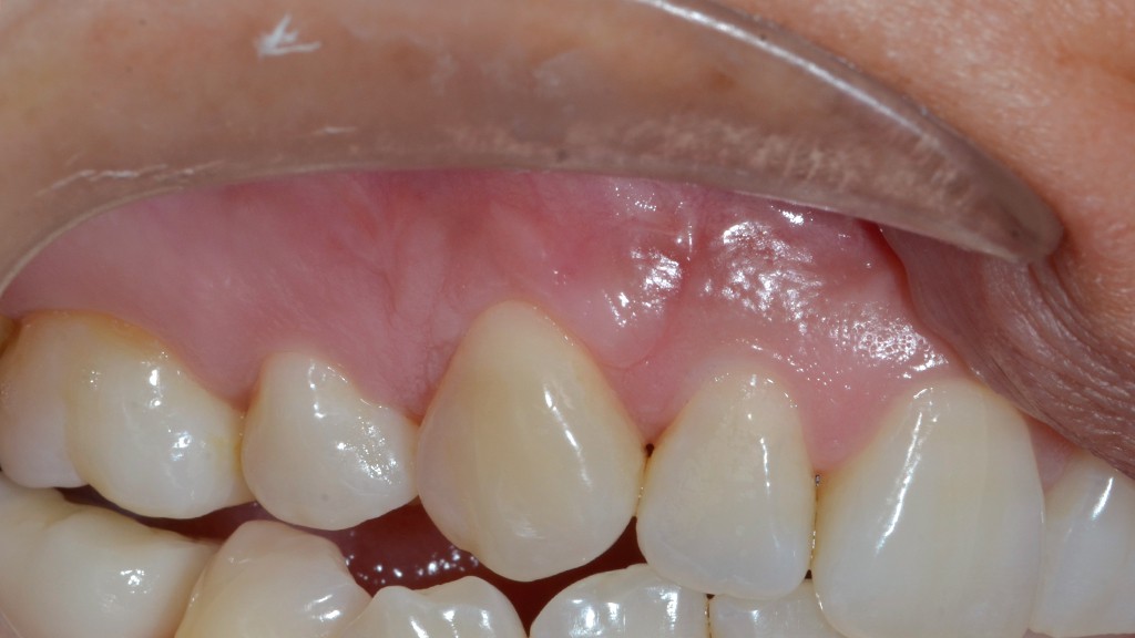 recesión gingival por cepillado traumático despues