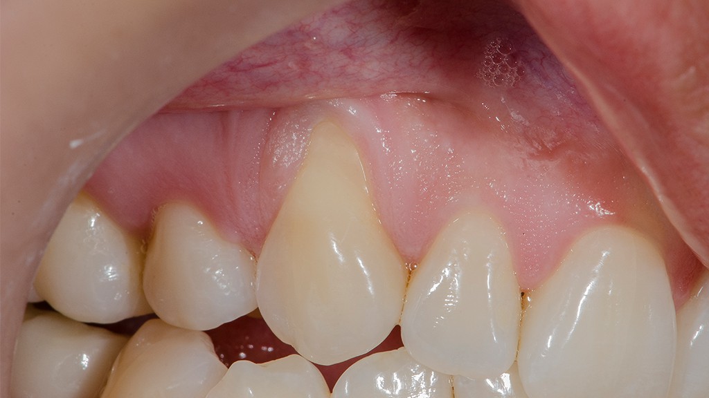 recesión gingival antes