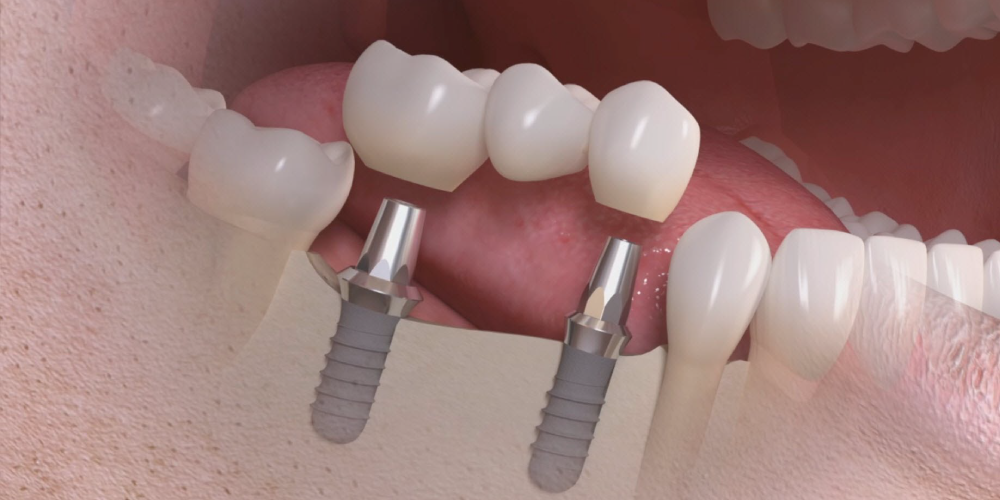 implantes con liquen plano