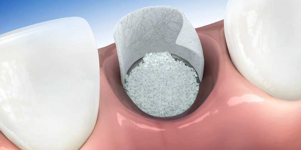 material oseo para injerto dental